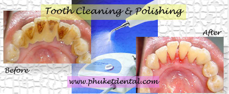 Tooth Cleaning&Air Flow/Polishing at Phuket Dental Clinic,Thailand